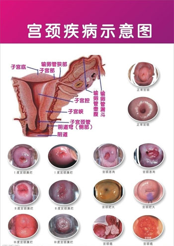 宮頸白斑的病因是什么？